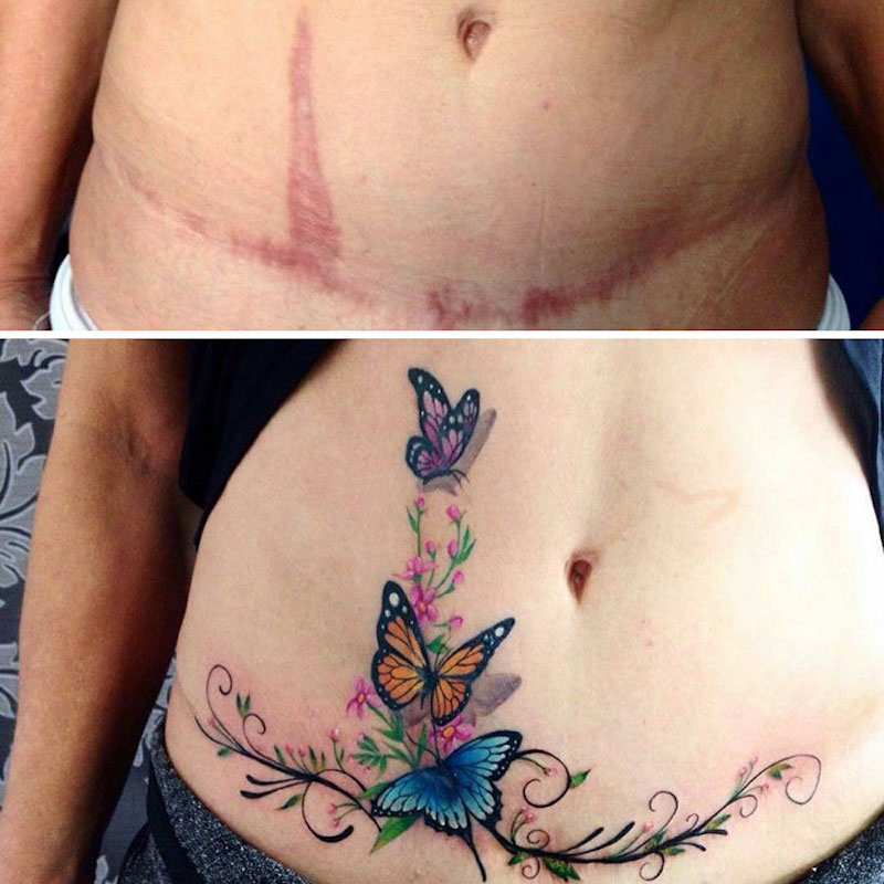 30 tatouages créatifs qui transforment des cicatrices en véritables œuvres d’art ! By Mélissa N.  Tatouages-masquent-cicatrices-18