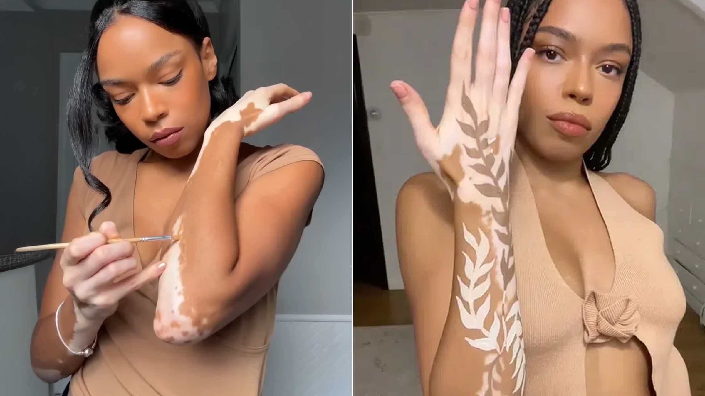 L’artiste Amara Aleman transforme ses taches de vitiligo en œuvre d’art